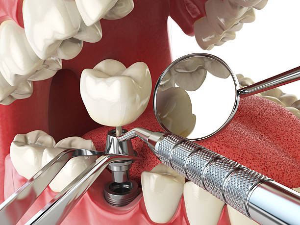 Best Emergency Dental Extractions in Valdese, NC
